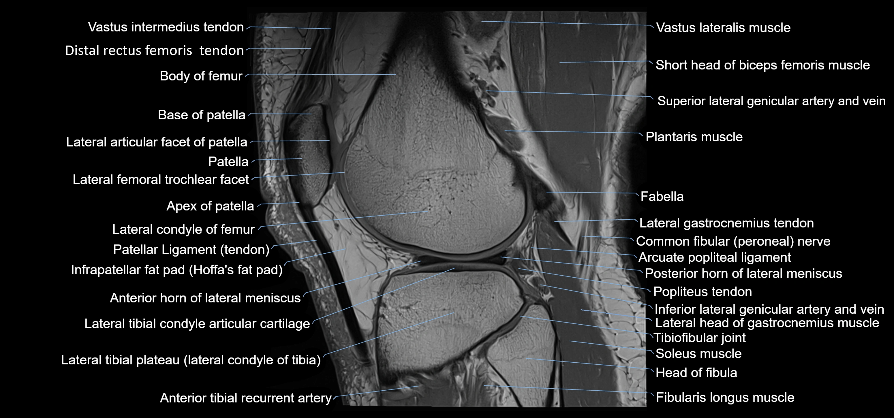 MRI knee sagittal cross sectional anatomy labelled 3T radiology image-00036.webp